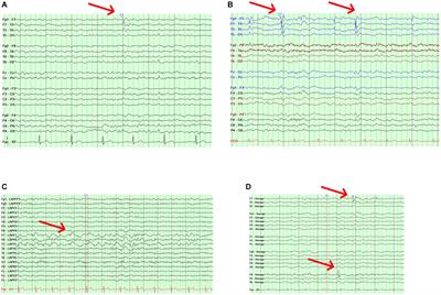 Interictal epileptiform discharges in Alzheimer’s disease: prevalence, relevance, and controversies